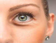 أهم 5 طرق للتخلص من انتفاخ العيون