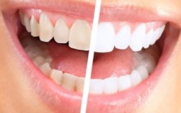 أسهل الطرق للحصول على أسنان بلا جير