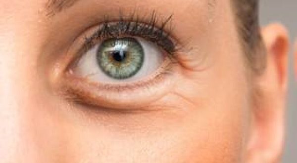 أهم 5 طرق للتخلص من انتفاخ العيون